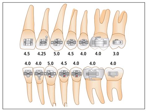 metal bracket gauges|bracket positioning chart.